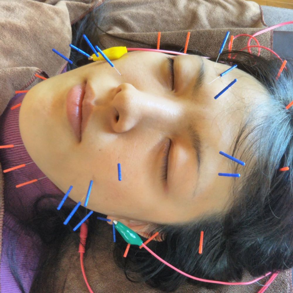 美容鍼