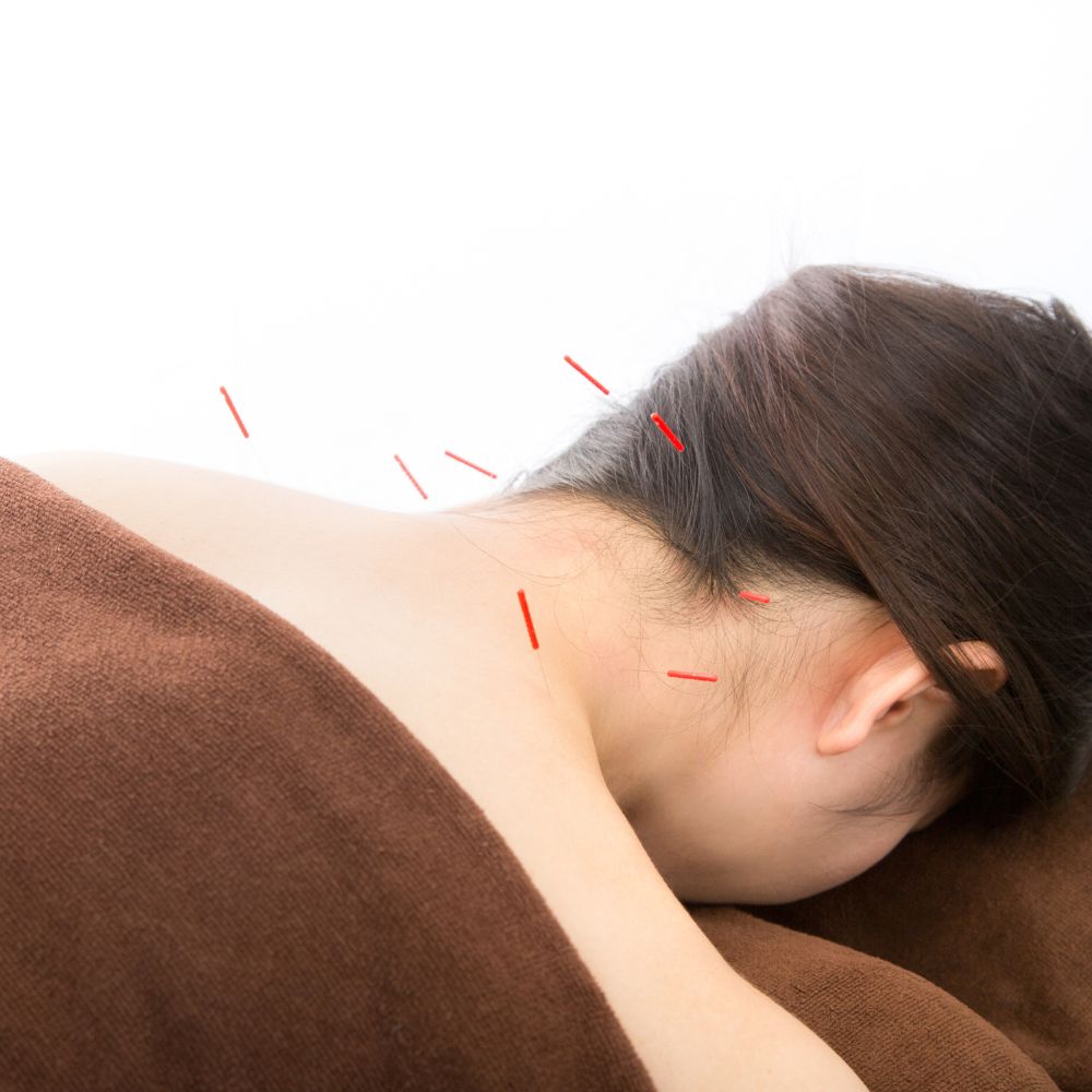 鍼灸の様子